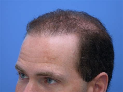 anderson hair restoration